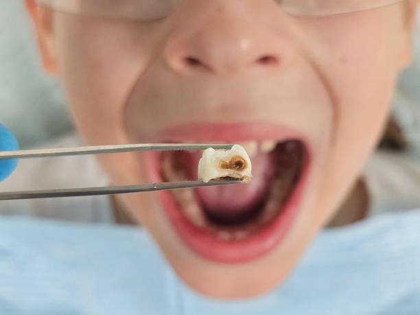 Best Root Canal Emergency Dentist  in Buckhead, GA